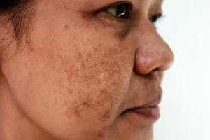 guia-melasma