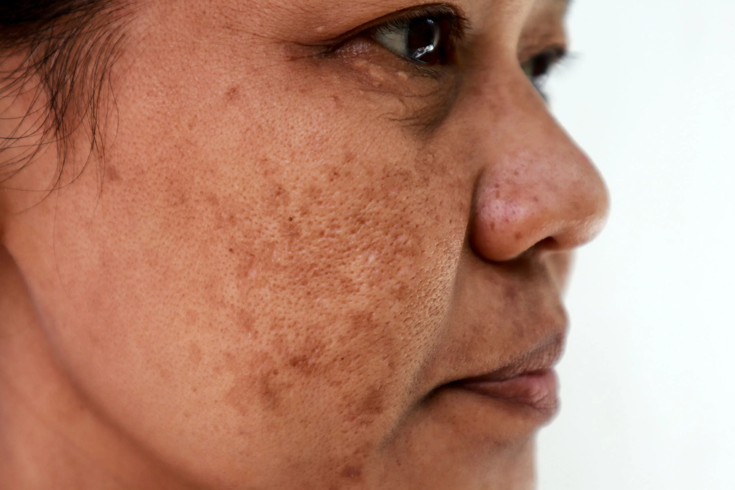 guia-melasma