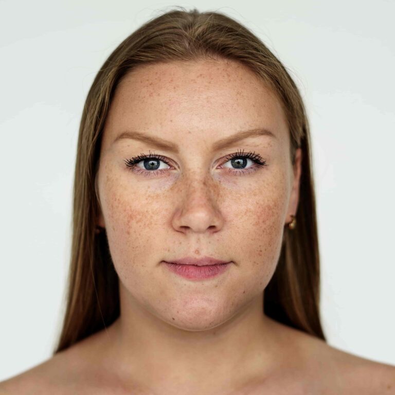 melhores clareadores para melasma