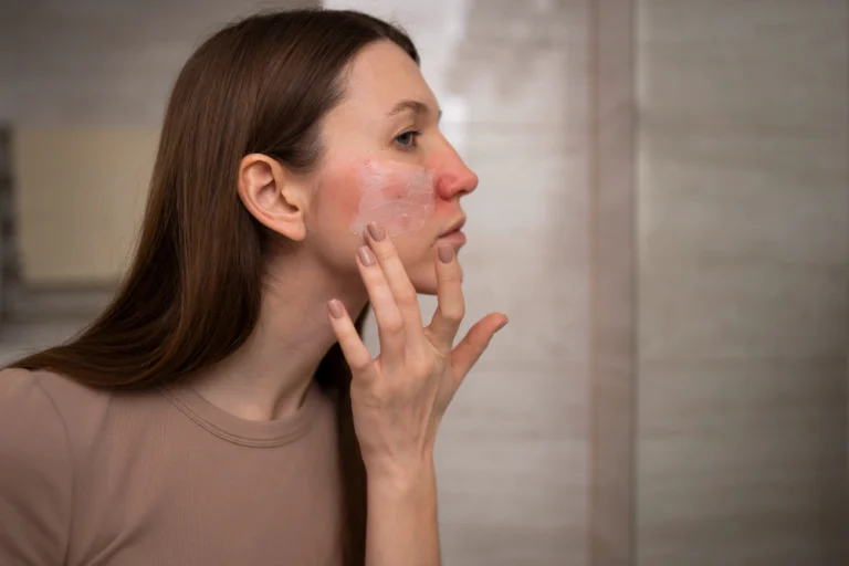protetor-solar-para-rosacea